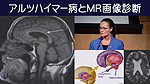アルツハイマー病と MR 画像診断