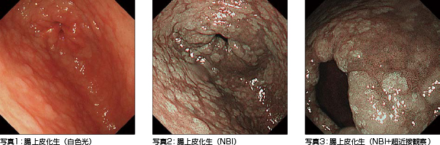 上部消化管の腸上皮化生の診断