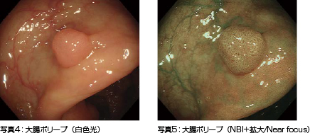 下部消化管において大腸腫瘍に対するNBI拡大観察